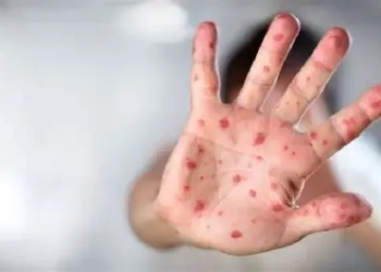 Boalemo tak ada kasus kematian akibat penyakit campak.(f.ilustrasi)